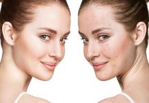 Cicatrices de acné que persisten en el tiempo: ¿es posible liberarse de ellas?